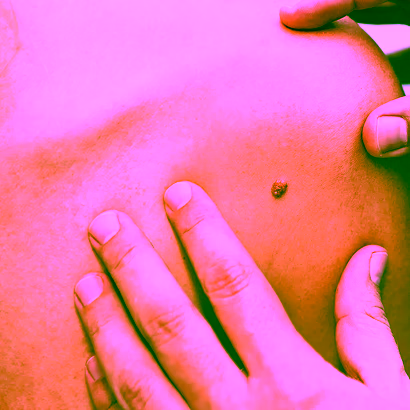 Skin cancer screening examination